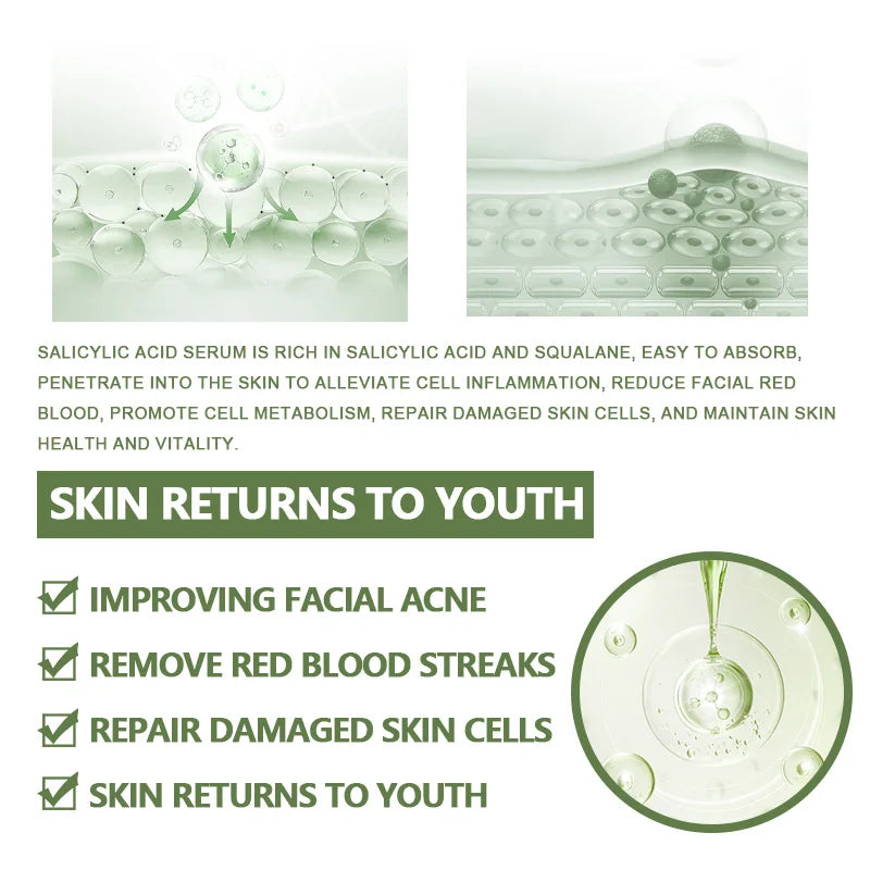 Anti-Acne Face Serum – Salicylic Acid Acne Removing Essence with Squalane & Vitamin E